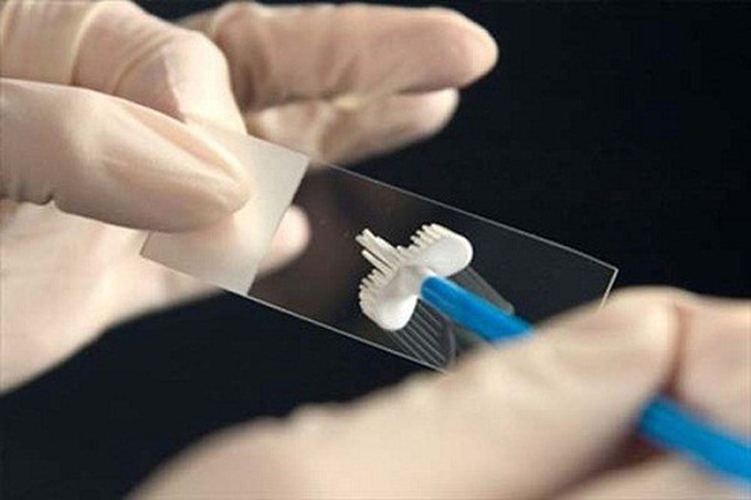 Ý nghĩa của xét nghiệm Pap với ung thư cổ tử cung