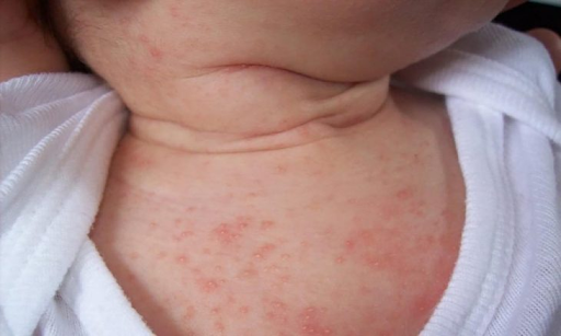 Mẹ bỉm sữa không thể bỏ qua 2 bước đơn giản này nếu muốn xử lý nhanh rôm sảy cho bé!